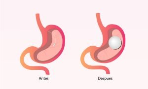 balon-grastrico-Precio